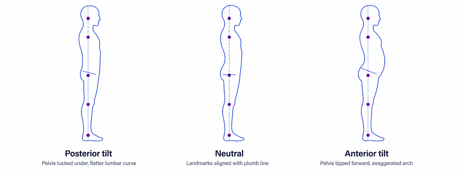 Three side-view silhouettes comparing posterior pelvic tilt, neutral pelvis, and anterior pelvic tilt