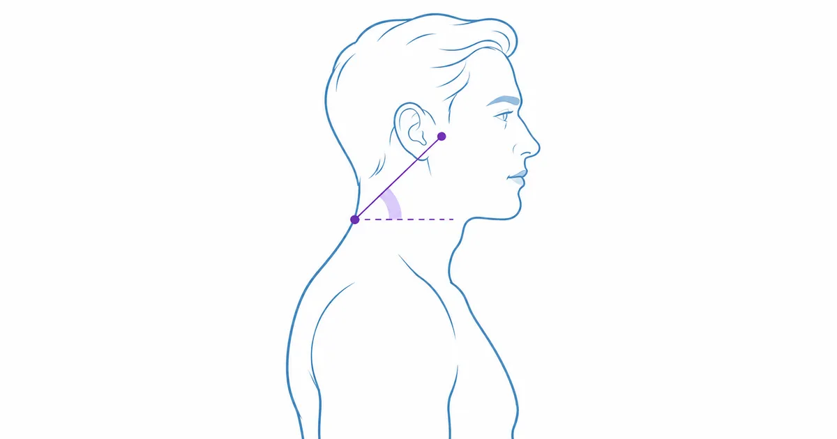 Craniovertebral Angle: How Forward Head Is Measured and What's Normal