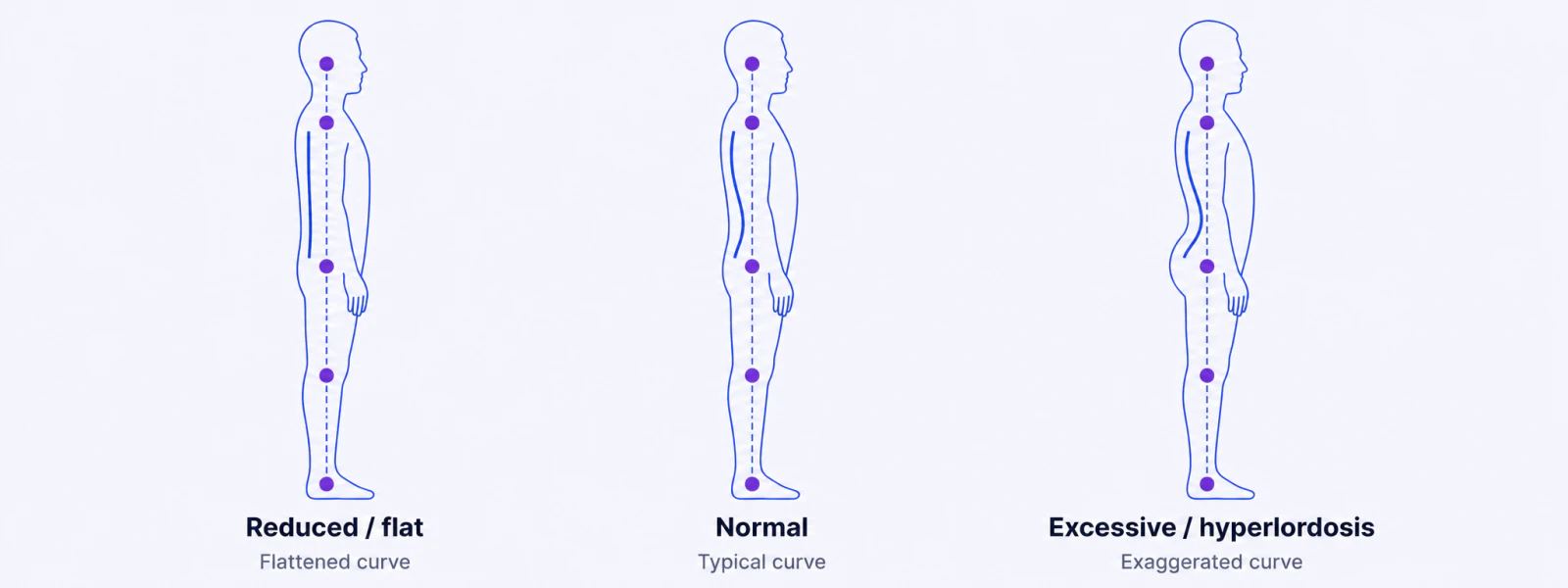 Three side-view illustrations comparing a flattened lower-back curve, a normal lumbar lordosis, and an exaggerated hyperlordosis
