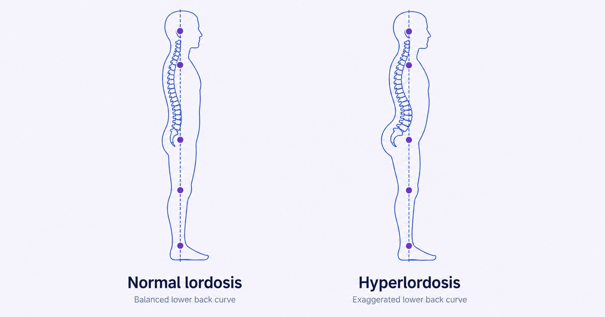 Lumbar Lordosis: What the Lower-Back Curve Looks Like