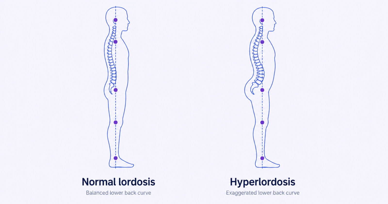 Lumbar Lordosis: What the Lower-Back Curve Looks Like