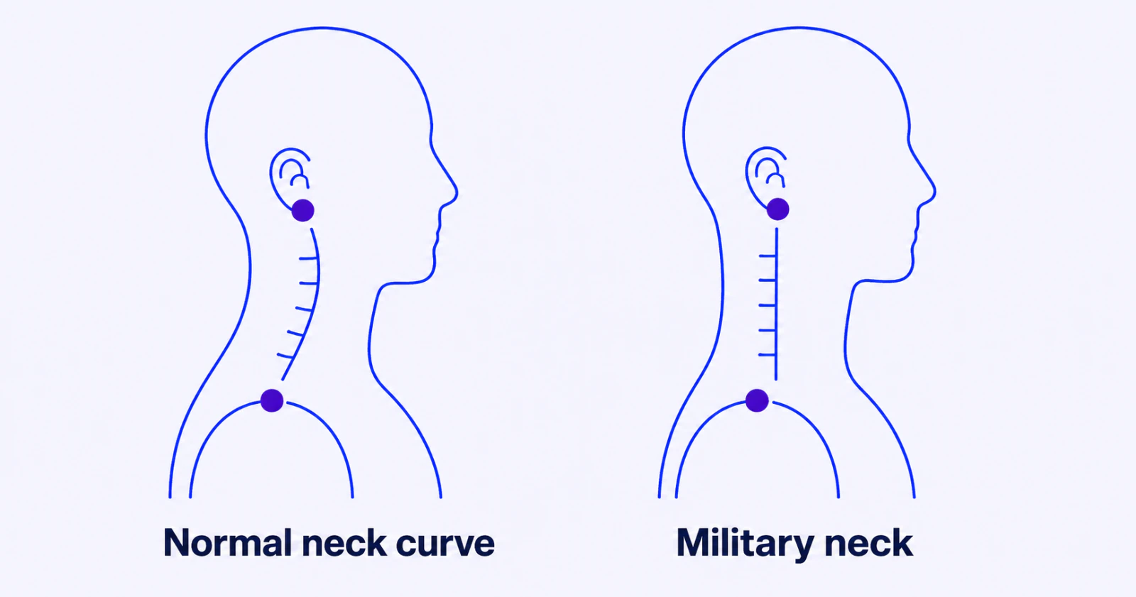 Military Neck: What a Straightened Neck Curve Means