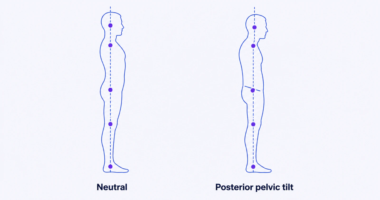 Posterior Pelvic Tilt: What It Looks Like in 2D Photos