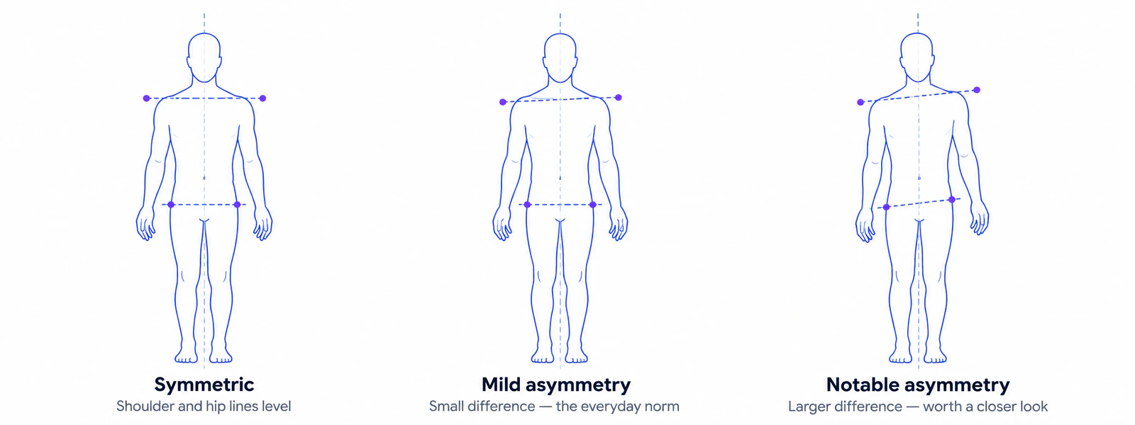 Three front-view figures showing symmetric posture, mild asymmetry, and notable asymmetry along a spectrum