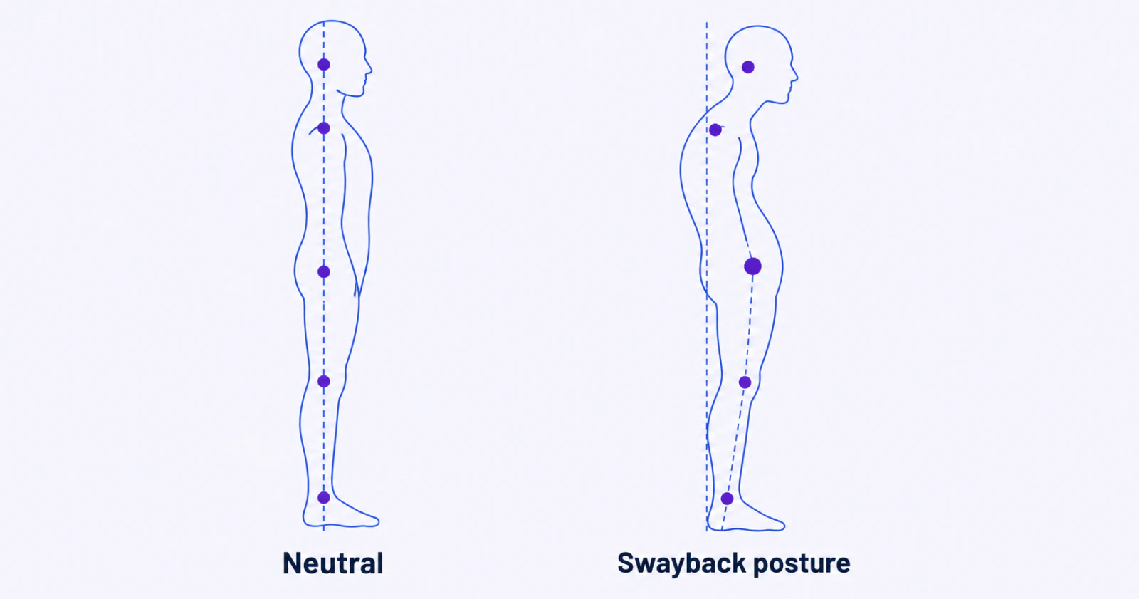 Swayback Posture: What It Is and What It Looks Like
