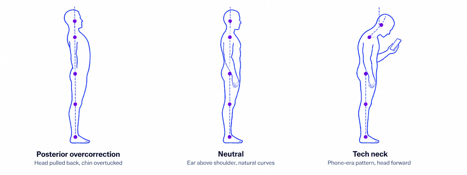 Three-figure comparison showing posterior overcorrection on the left, neutral standing posture in the center, and tech neck on the right, illustrating the cervical posture spectrum