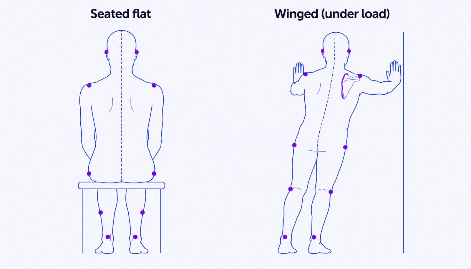 Back view illustration showing a winged scapula with the inner border of the shoulder blade lifting away from the ribcage, contrasted with a flat shoulder blade