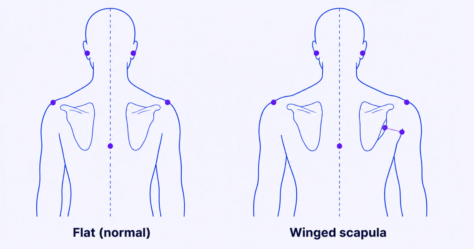 Winged Scapula: What a Protruding Shoulder Blade Looks Like